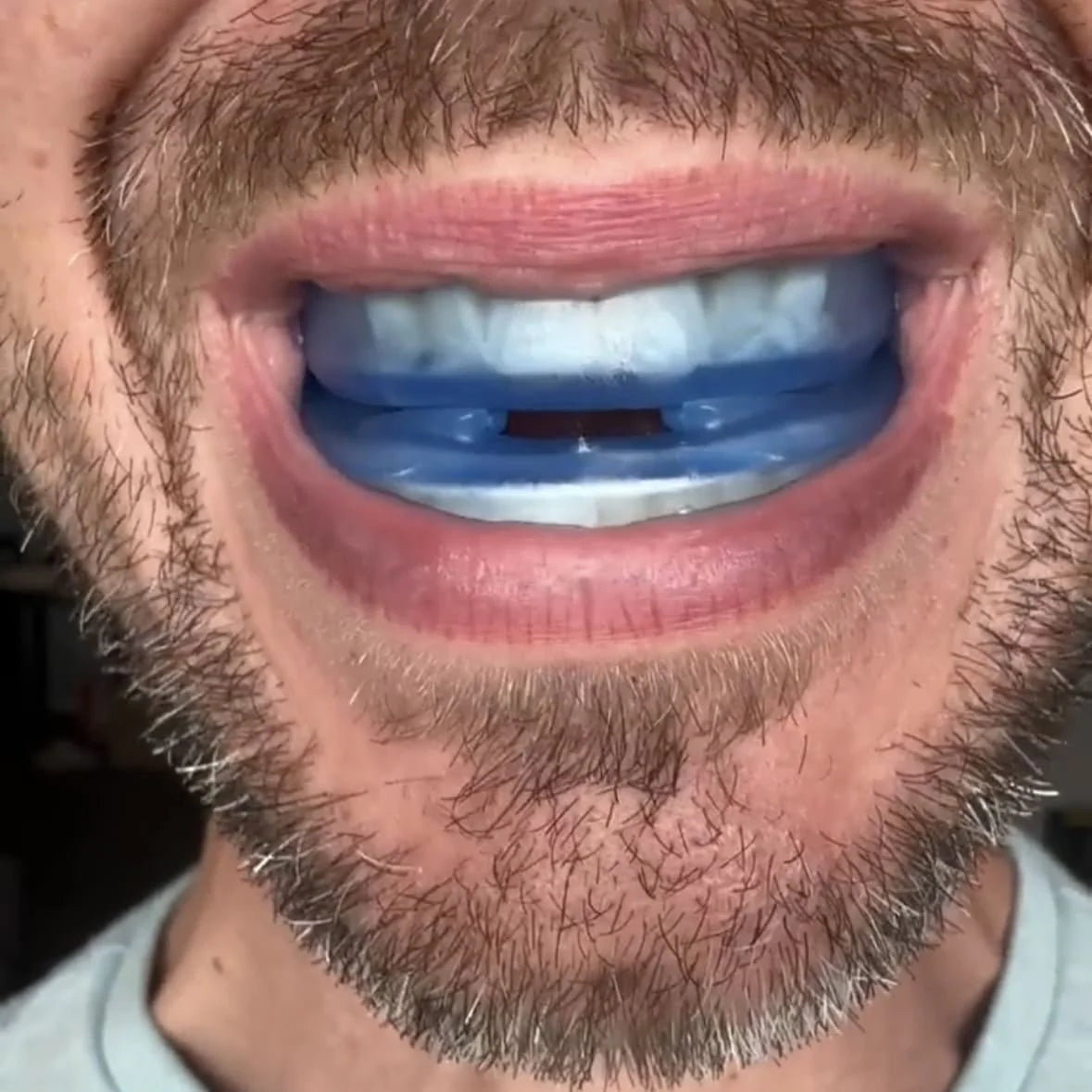 Airvex Pro Anti-Snoring Mouth Guard™